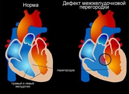 хипертония на сърцето на лявата камера